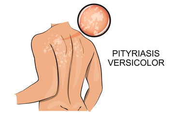 pityriasis versicolor. dermatology.