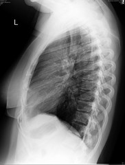 Chest X-ray image of woman