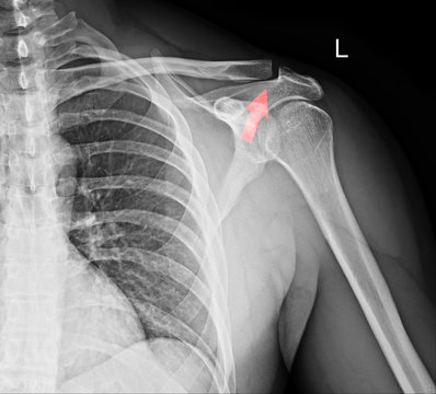 X-ray film of shoulder fracture
