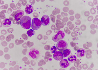 a precursor cell, also called a blast cell or simply blast, is a