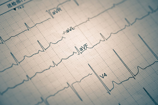 Electrocardiogram