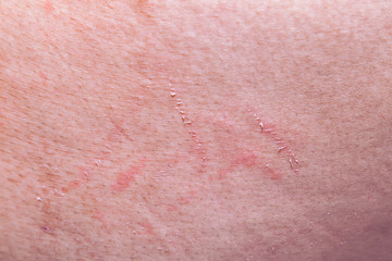 abrasion wound on the skin from scratching.