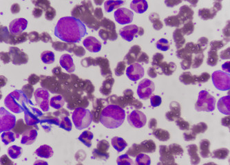 Blast cells in Leukemia