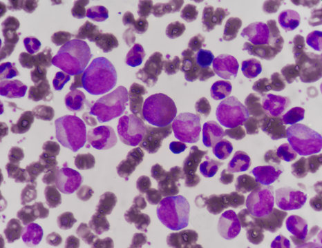 Blast cells in Leukemia