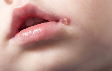 Naklejka premium sore on the lip of the child . herpes