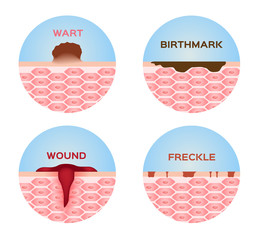 wart , wound , freckle and birthmark skin icon , logo and vector medical - obrazy, fototapety, plakaty