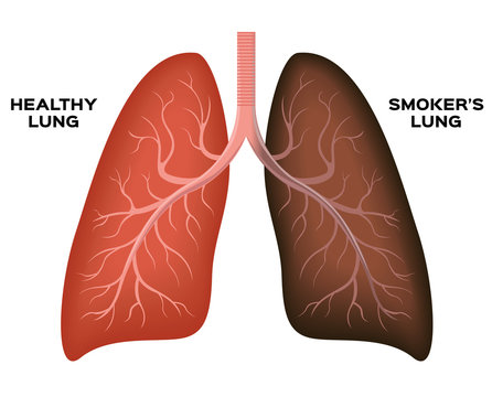 Normal lung , smoker's lung vector