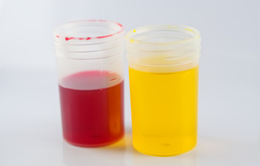 Yellow and Red Urine for Medical Urine Analysis