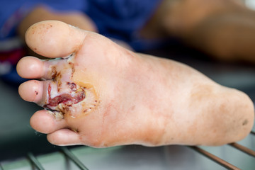 infected wound of diabetic foot
