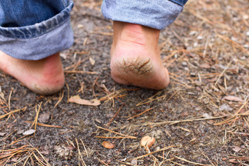 Close up photo pair of cracked heels. Male back view.