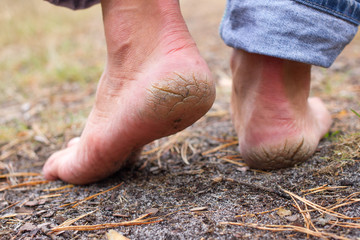 Close up photo pair of cracked heels. Male back view.