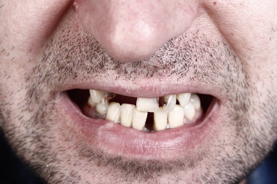 Unhealthy teeth