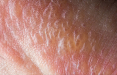 Fototapeta premium Poison Ivy Rash