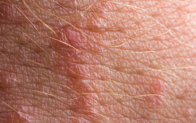 Fototapeta premium Poison Ivy Rash