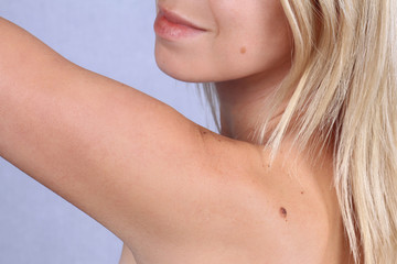 Checking benign moles : Woman with birthmarks on her skin