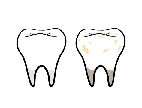 Tooth Vector Set. A hand drawn vector illustration of a clean tooth and a dirty tooth.