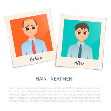 Vector illustration of two photographs of a man before and after hair treatment and hair transplantation. Male hair loss design template. Alopecia medical concept. Vector illustration.