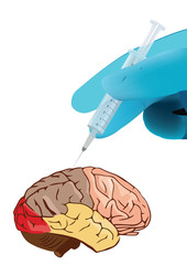 iniezione al cervello