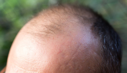 Fototapeta premium hair loss on the head of a man