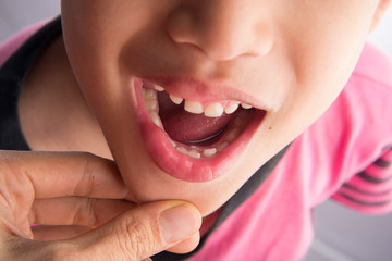 Little boy with the first new permanent teeth