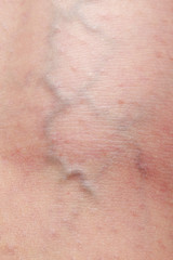 the phlebeurysm on legs