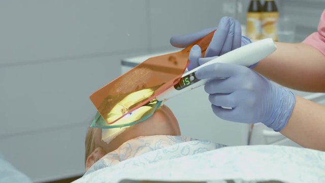 Dentist ultraviolet light illuminates the photopolymer filling