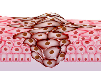Growing Tumor, Tissue Section - Vector Illustration