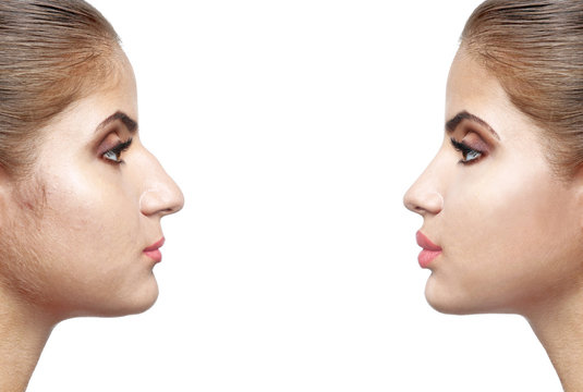 Woman face before and after cosmetic procedure. Plastic surgery concept.