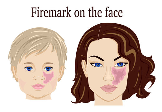 Port-wine stain on the face of the child and adult