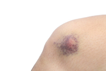 Fototapeta premium close up on a bruise on knee skin