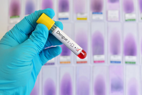 Blood sample positive with dengue virus test
