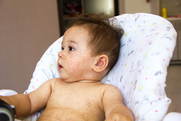 baby with dermatitis problem of rash. Allergy suffering from food allergies. Close-up atopic...