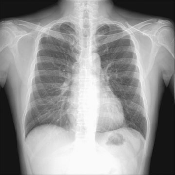 pneumothorax seen in chest radiography which want to intercostra