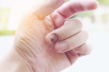 Fungal nail infection and damage on human hand. Finger with onychomycosis