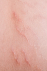 Closeup on stretch marks or cellulite on waist belly