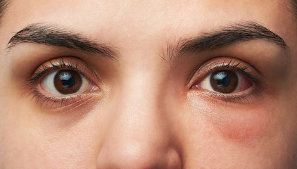 Fototapeta premium allergy reaction on eye