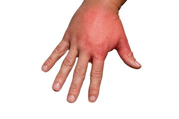 geschwollene Hand nach Insektenstich