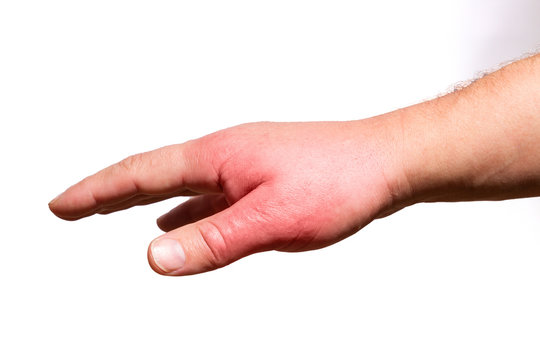 allergische Reaktion nach Insektenstich