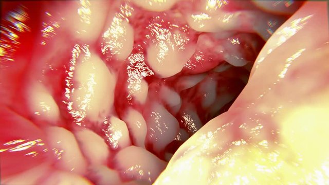Crohn's disease intestine