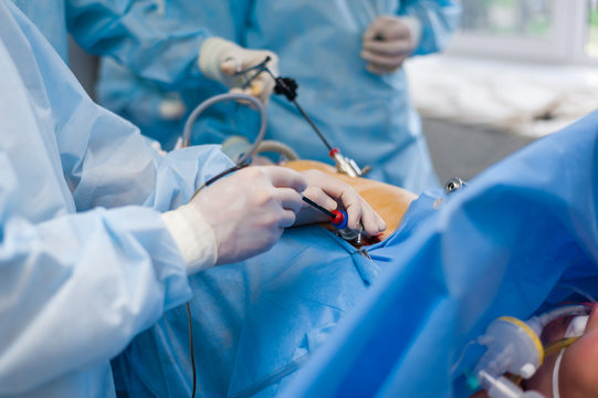 Cholecystectomy using an endoscope
