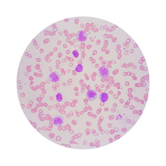 Microscopic view of a blood smear from leukemia patient showing
