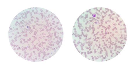 Microscopic views of a thin blood smear from malaria infected pa