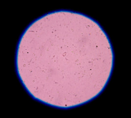 calcium oxalate crystal in urine analysis.