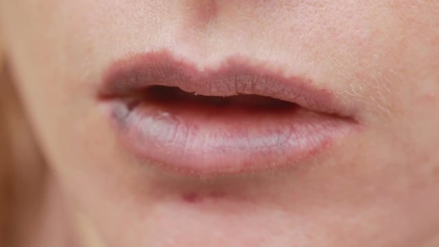 female lips with bruise. close-up. effects of hyaluronic acid. lip augmentation