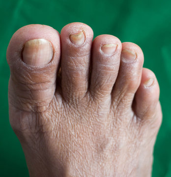 Complications of diabetes , Dermatophyte