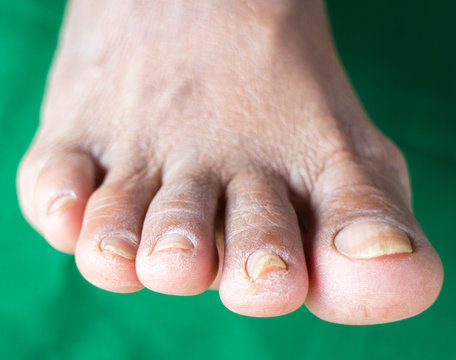 Complications of diabetes , Dermatophyte