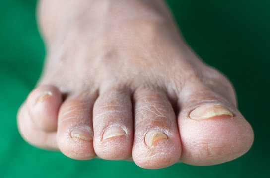 Complications of diabetes , Dermatophyte