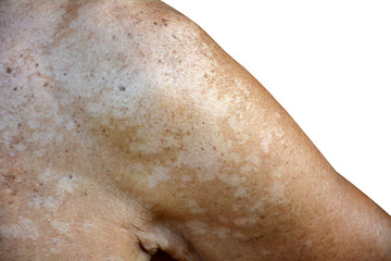 Tinea versicolor/Pityriasis versicolor on the skin select focus