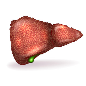 Cirrhosis of the Liver anatomy illustration