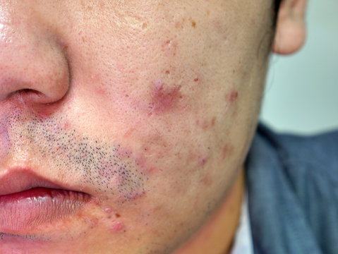 Man with skin and scars from acne close up